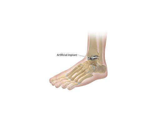 Ankle replacement