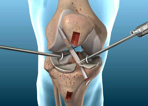 Knee arthroscopy